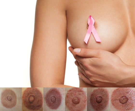 3D Areola Reconstruction tattoos in Perth