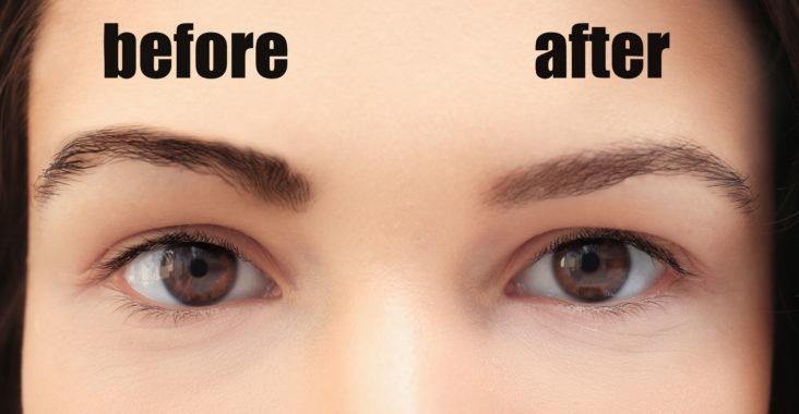 tattoo removal