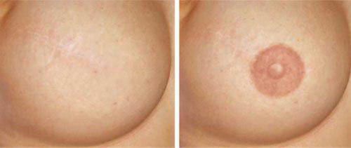 Areola Tattoo Perth - Areola Restoration Tatto - Areola Pigmentation Tattoo Areola Tattoo Perth - Areola Restoration Tatto - Areola Pigmentation Tattoo