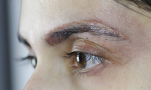 Eyebrow tattoo removal before and after