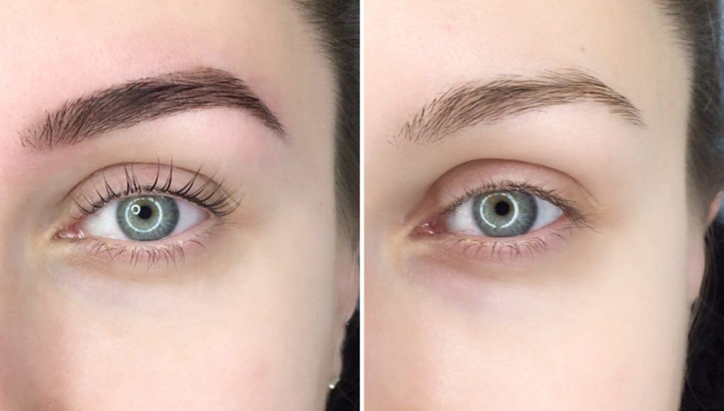 Eyebrow tattoo removal