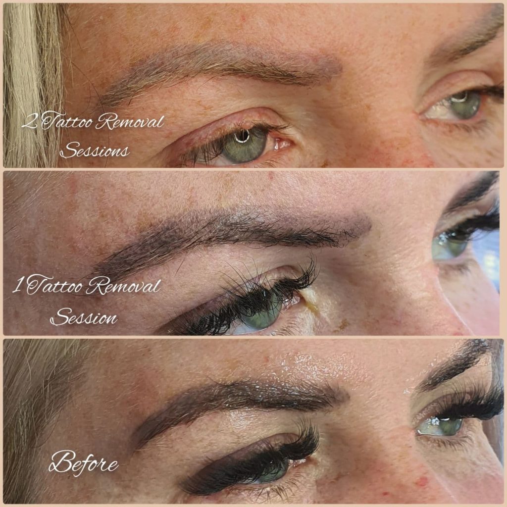 Eyebrow Tattoo Removal Melbourne Victoria  Eye Art Studio