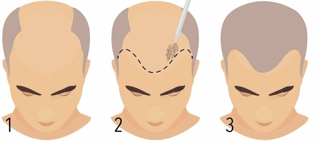 scalp micropigmentation perth