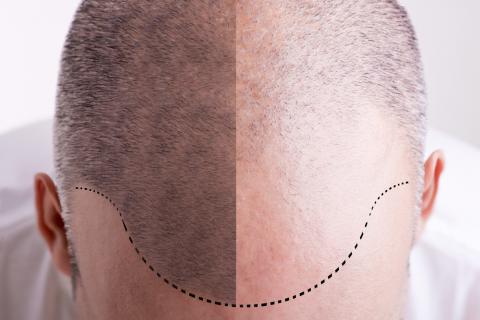 scalp micropigmentation perth