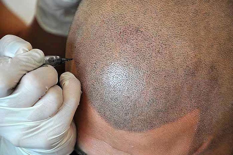 scalp micropigmentation perth