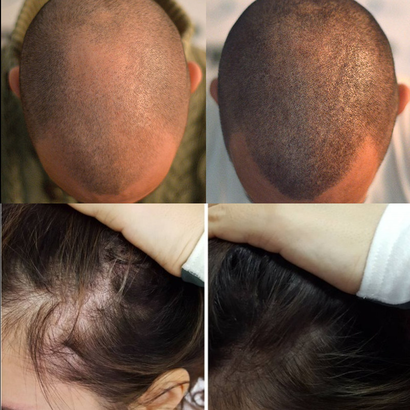 scalp micropigmentation perth