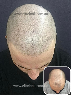 scalp micropigmentation Perth