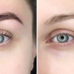 eyebrow tattoo removal