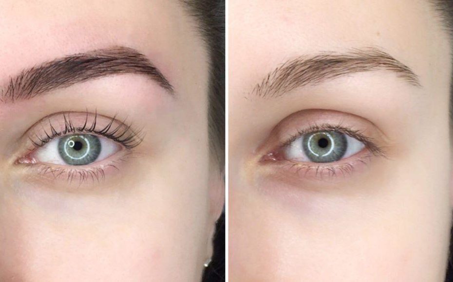 eyebrow tattoo removal