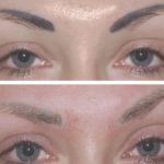 eyebrow tattoo removal Perth