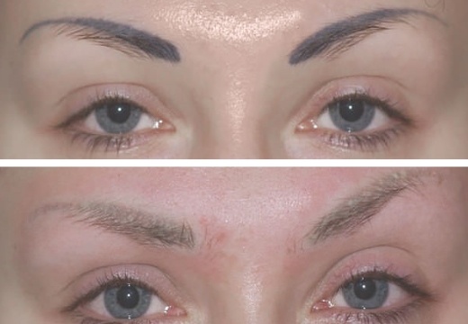 eyebrow tattoo removal Perth