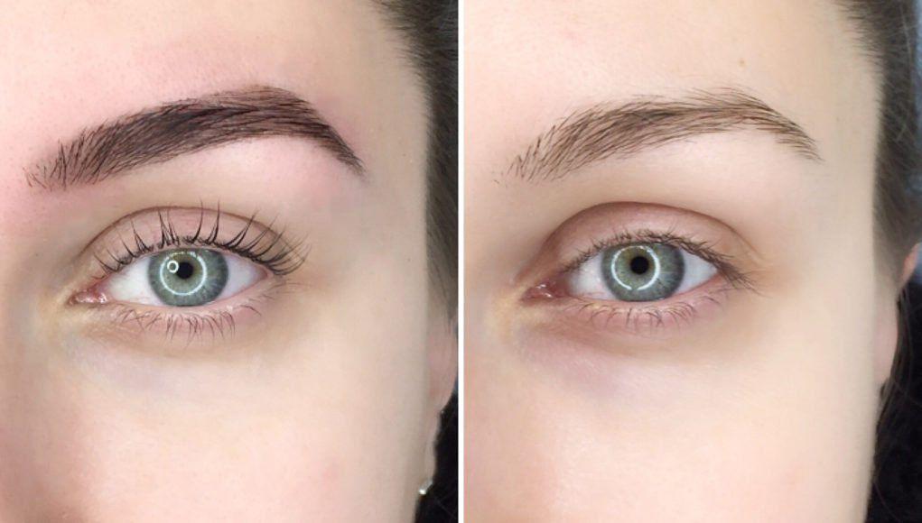 eyebrow tattoo removal